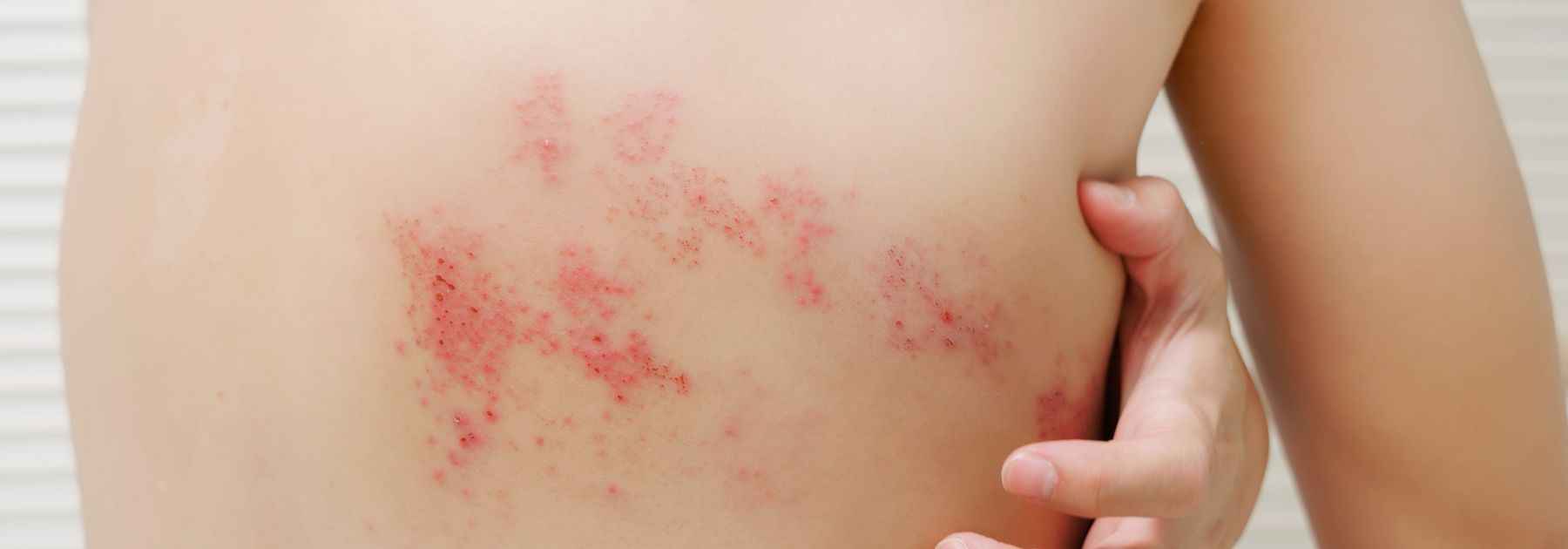 shingles pharmacy first