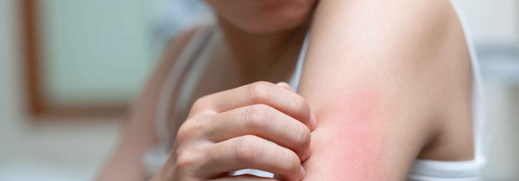 shingles pharmacy first