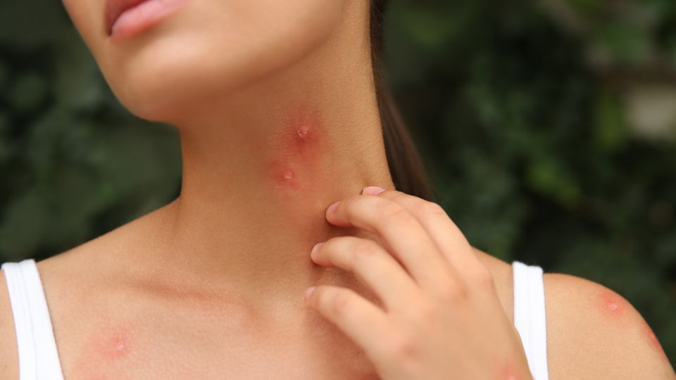 pharmacy first infected insect bites
