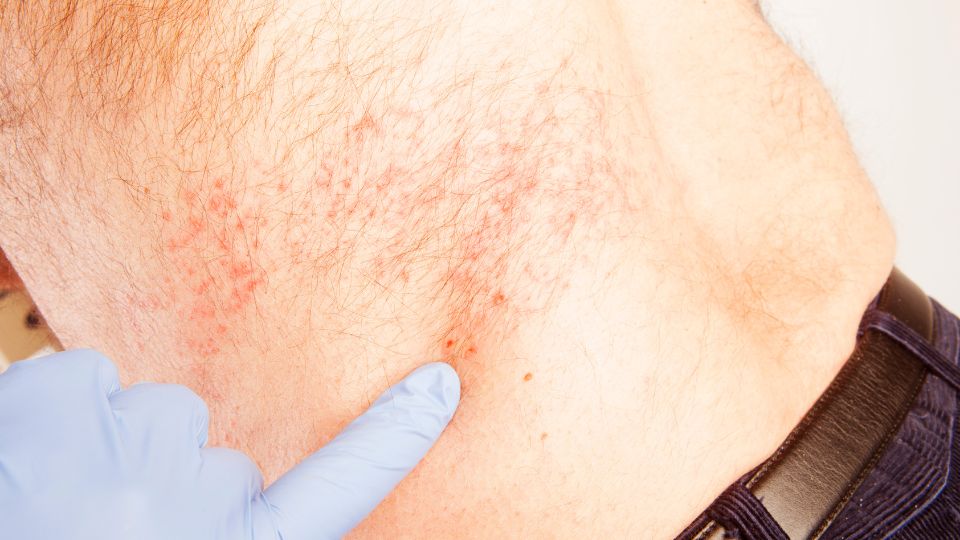 shingles pharmacy first